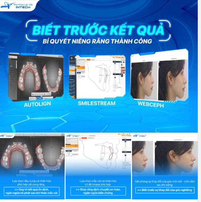 BIẾT TRƯỚC KẾT QUẢ - BÍ QUYẾT NIỀNG RĂNG THÀNH CÔNG CỦA MỌI KHÁCH HÀNG!