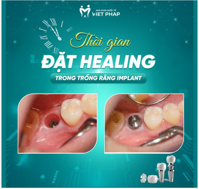 THỜI GIAN ĐẶT HEALING TRONG TRỒNG RĂNG IMPLANT