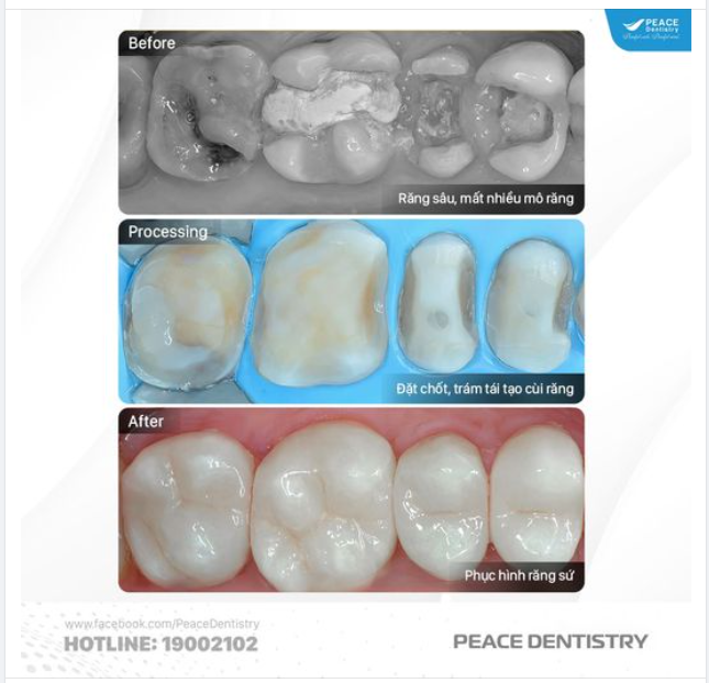 ĐẶT CHỐT, TRÁM TÁI TẠO CÙI RĂNG PHỤC HÌNH RĂNG SỨ: Một chỉ định rất phổ biến để phục hình các răng bị hư hại trầm trọng.