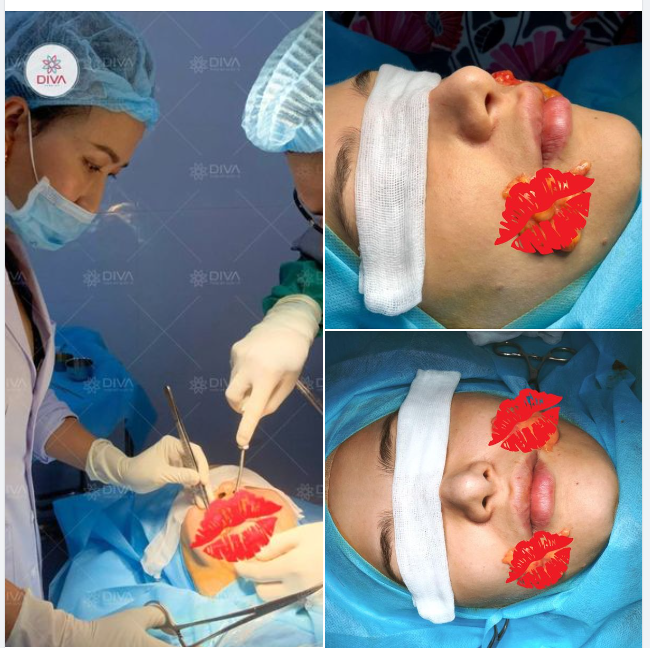 SAU LẤY MỠ MÁ CÓ BỊ SƯNG NHIỀU KHÔNG?