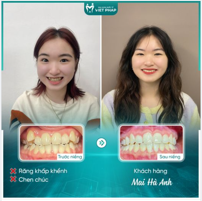 CƯỜI NHIỀU HƠN, HẠNH PHÚC NHIỀU HƠN SAU NIỀNG INVISALIGN