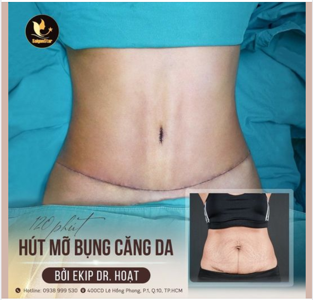 120 PHÚT HÚT MỠ CĂNG DA - BIẾN GIẤC MƠ THÀNH HIỆN THỰC
