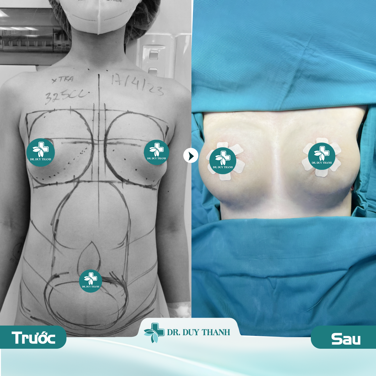 Dr Duy Thanh nâng ngực, treo sa trễ không sẹo, không nghỉ dưỡng