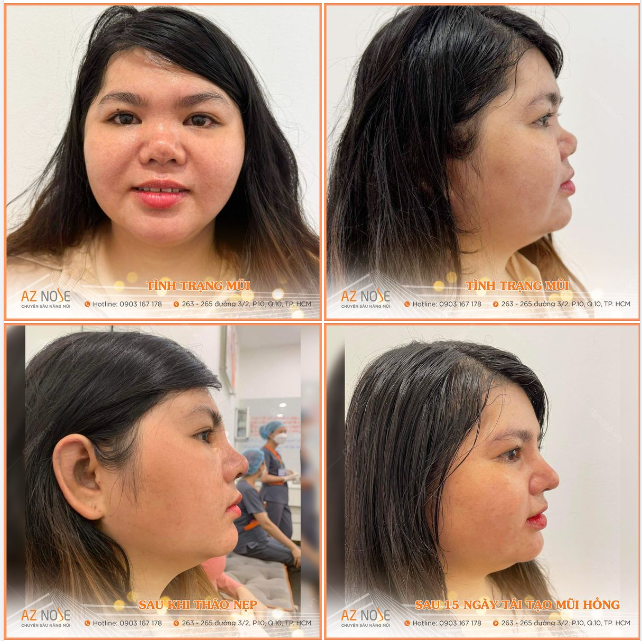Khắc phục mũi co rút cho khách hàng 9X đến từ Thuận An, Bình Dương
