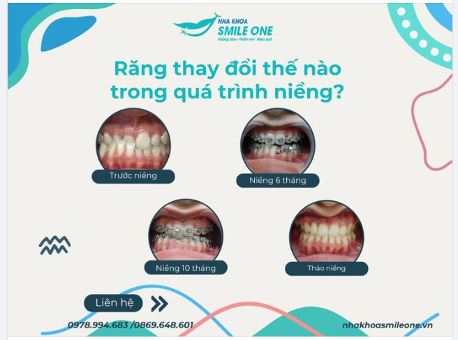 Răng sẽ thay đổi như thế nào trong quá trình niềng?