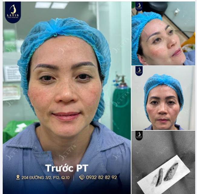 Nâng cung mày đa tầng - Trẻ hóa tuổi xuân