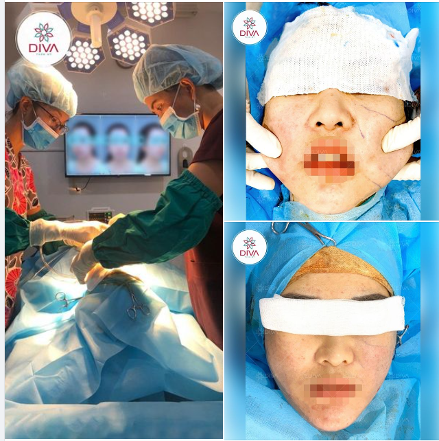 SAU GIẢM MỠ MẶT - GƯƠNG MẶT NHẸ NHÀNG, THON GỌN