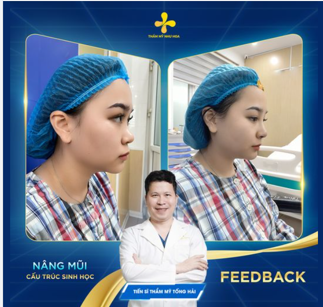 Update sự thay đổi của bạn Lê Huyền ngay sau khi thực hiện dịch vụ nâng mũi cấu trúc sinh học.