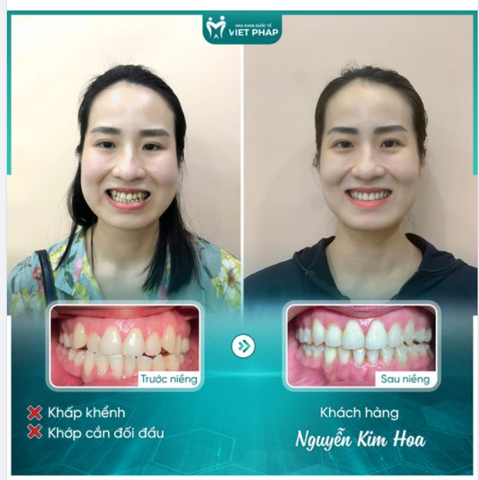 NIỀNG INVISALIGN - GIẢI PHÁP TỐI ƯU ĐỂ CÓ NỤ CƯỜI RẠNG RỠ