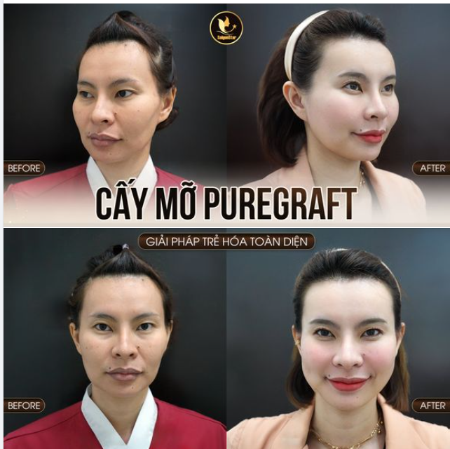 CẤY MỠ MẶT CÔNG NGHỆ PUREGRAFT TRẺ HÓA TOÀN DIỆN - NÍU GIỮ THANH XUÂN CHỈ SAU 1 LẦN THỰC HIỆN