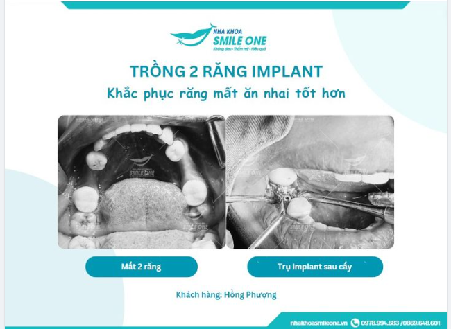Trồng 2 răng implant khách hàng Hồng Phượng 26 tuổi
