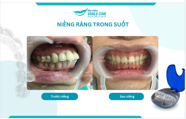 Không ít bạn gặp phải tình trạng răng hô và gửi gắm nụ cười của mình vào phương pháp niềng răng. Với trường hợp răng hô, bạn có thể cân nhắc từ niềng răng mắc cài đến không mắc cài.