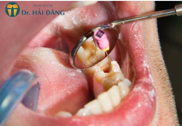 5 LÝ DO BẠN CẦN CHỮA TỦY RĂNG KHI ĐƯỢC CHỈ ĐỊNH