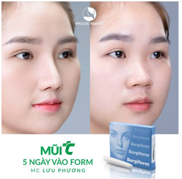Xoá sổ sống mũi thấp, MC Lưu Phương đã chọn Mũi TC