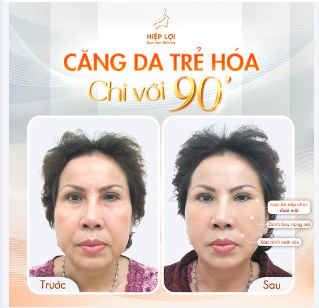 Feedback khách hàng CĂNG DA TRẺ HÓA - Chỉ với 90 phút.