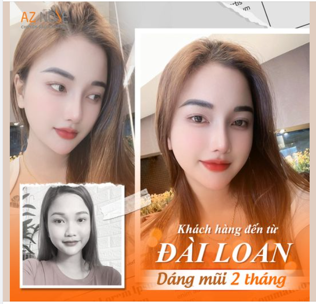 Tự tin và thần thái hơn hẳn với dáng mũi 2 tháng tuổi. Nhanh tay xin vía "lột xác" thành công của chị B.L. đến từ Đài Loan nào!!