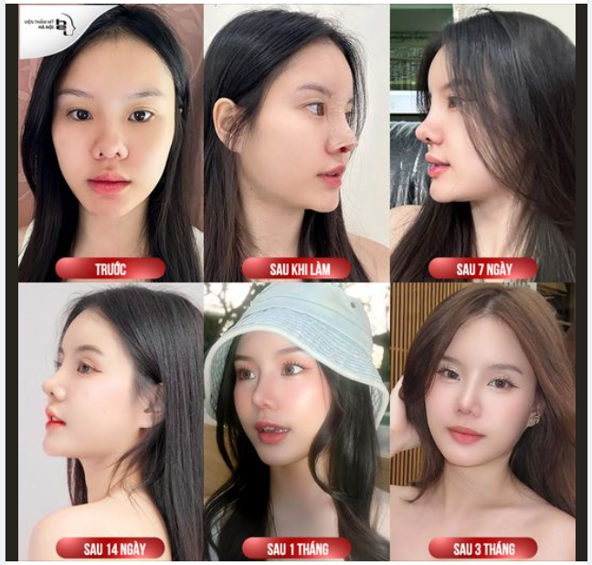 NÂNG MŨI BELLA SILK 5S - update diện mạo mới sau 45p