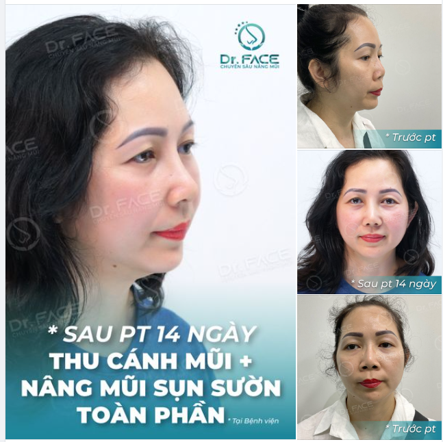 Mũi đẹp là thứ có thì tốt, Còn không có thì làm sụn sườn ngay và luôn…!