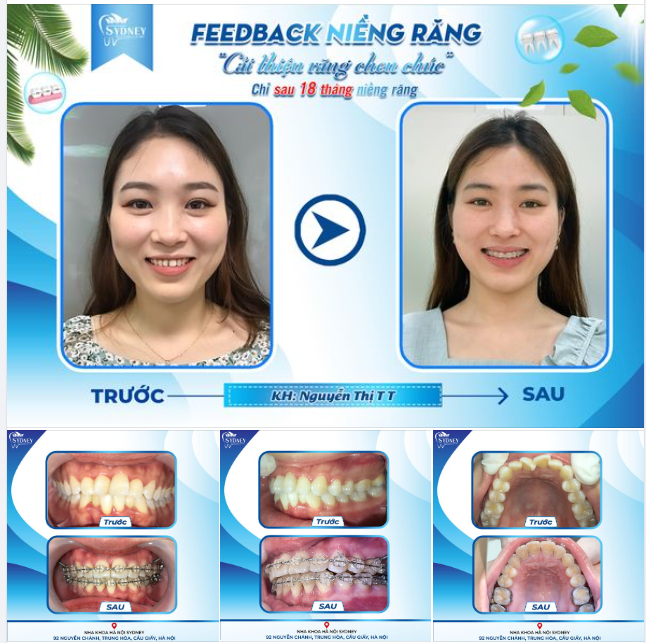CẢI THIỆN RĂNG CHEN CHÚC CHỈ SAU 18 THÁNG NIỀNG RĂNG