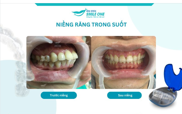 Không ít bạn gặp phải tình trạng răng hô và gửi gắm nụ cười của mình vào phương pháp niềng răng.