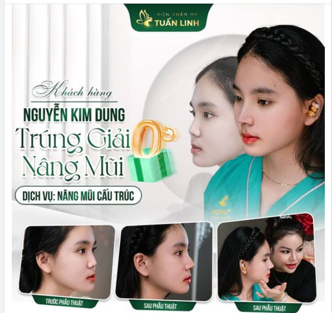 Bạn Nguyễn Kim Dung - Bình Dương - Dịch vụ: Nâng mũi cấu trúc.