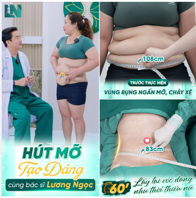 PHƯƠNG PHÁP HÚT MỠ TẠO DÁNG LÀ GÌ? CÓ AN TOÀN KHÔNG?