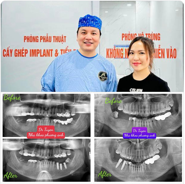 Hai trong 06 ca phẫu thuật cấy ghép Implant hôm nay của bác sĩ đều chung một cảm giác lo Âu, sợ đau trước khi làm … nhưng khi cấy xong thì chung một câu trả lời “Không đau bác sĩ ạ”