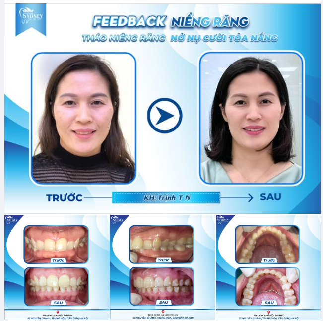 THÁO NIỀNG RĂNG - NỞ NỤ CƯỜI TỎA NẮNG