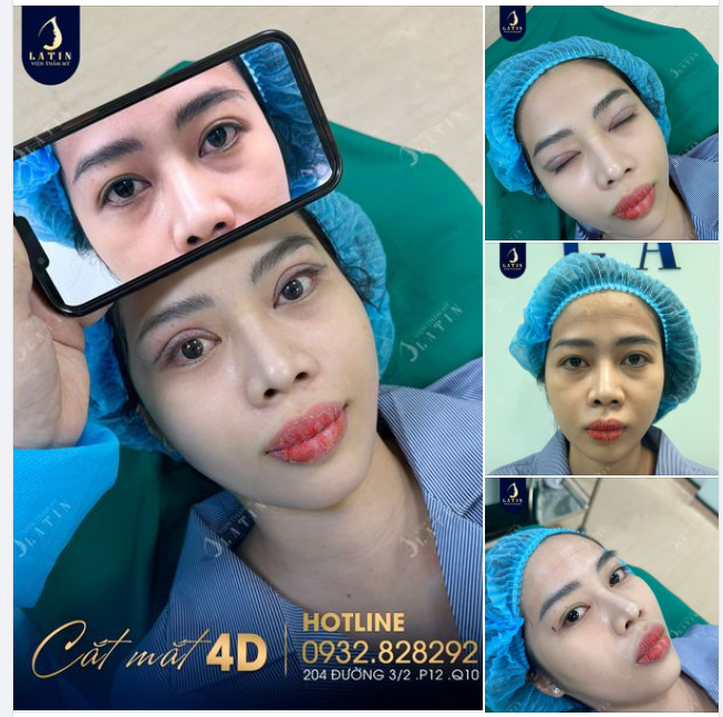 Khắc phục tình trạng nhược cơ, mắt đa mí