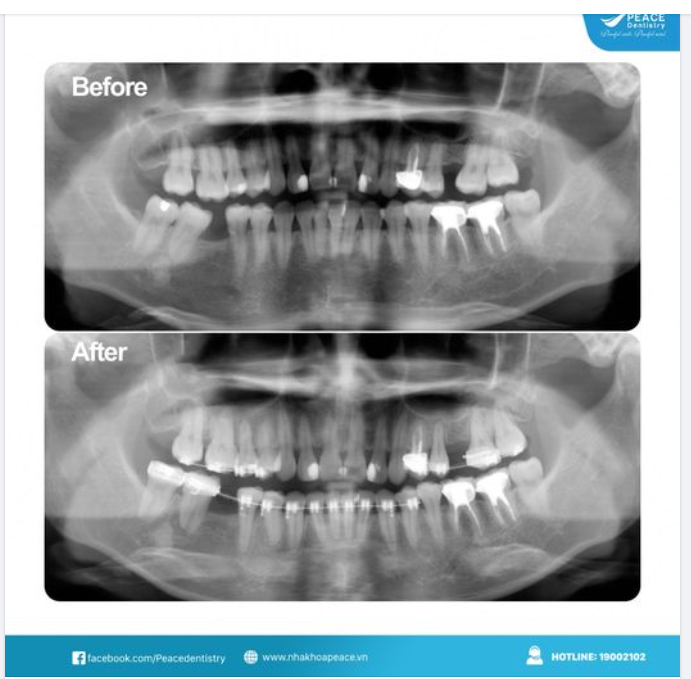 NIỀNG RĂNG TẠO KHOẢNG CẤY GHÉP IMPLANT | ĐIỀU TRỊ LIÊN CHUYÊN KHOA MANG LẠI KẾT QUẢ TỐI ƯU
