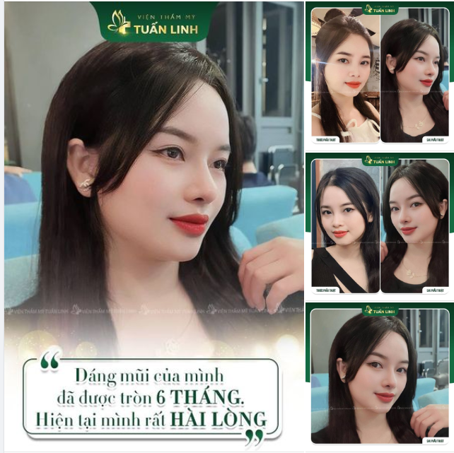 FEEDBACK NÂNG MŨI CẤU TRÚC SAU 6 THÁNG CỦA KHÁCH HÀNG NHÀ TUẤN LINH.