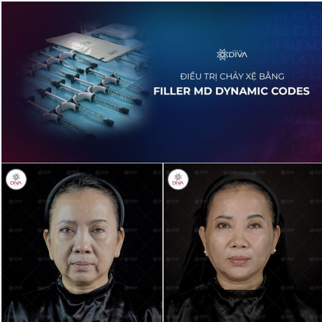 FILLER MD CODES: GIẢI QUYẾT HOÀN HẢO VẤN ĐỀ LÃO HÓA, CHẢY XỆ
