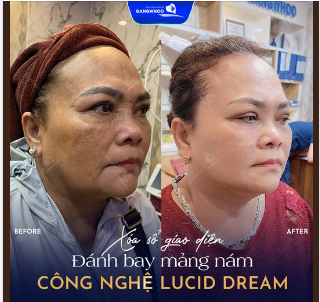 CÔNG NGHỆ LUCID DREAM xóa sổ giao diện đánh bay mảng bám