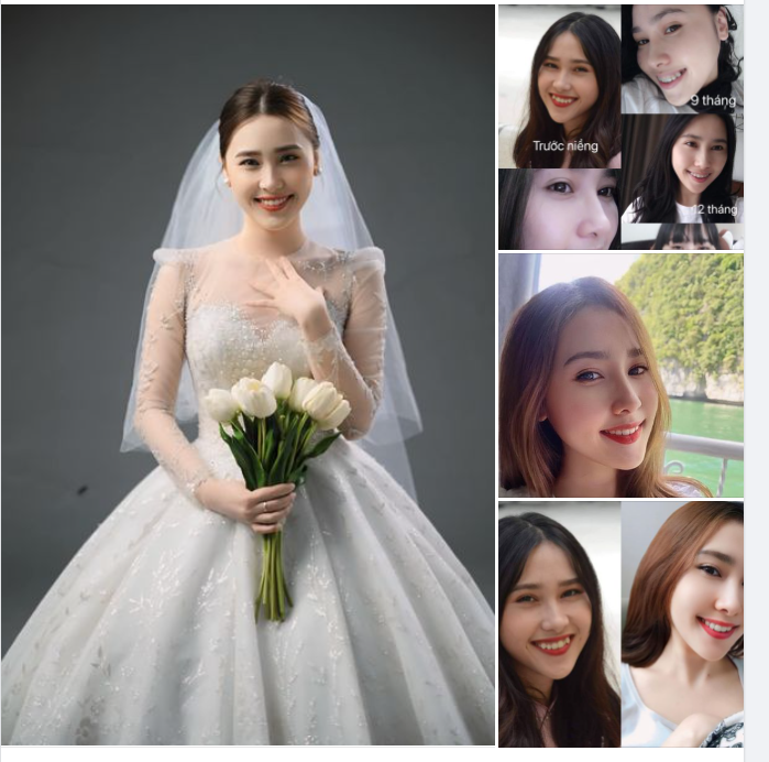 Chúc mừng Thanh Trang tạm biệt mắc cài sứ sau 1 năm 8 tháng với sự đồng hành của Nha khoa Paris!