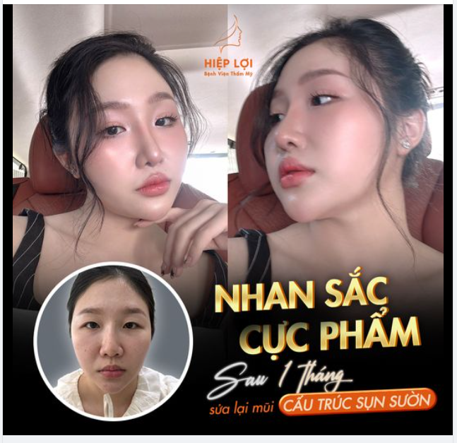 Nâng mũi SỤN SƯỜN có "đau" hay "không" thì chưa biết, mà biết "đẹp" là chắc rồi ạ