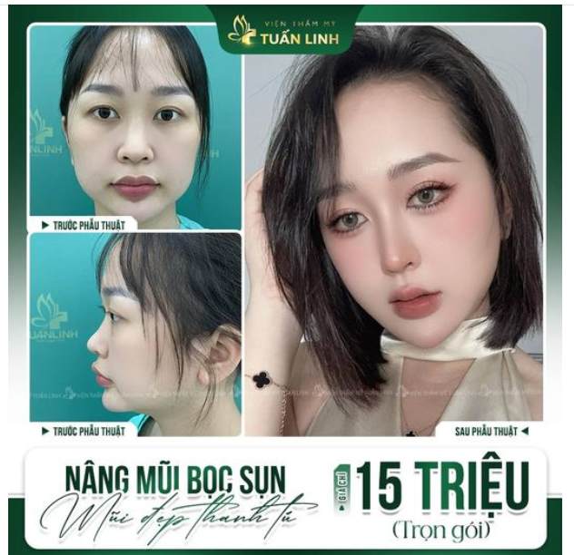 Nâng mũi Sline bọc sụn tai giá chỉ 15 Triệu trọn gói - Có hỗ trợ trả góp 0% Lãi!