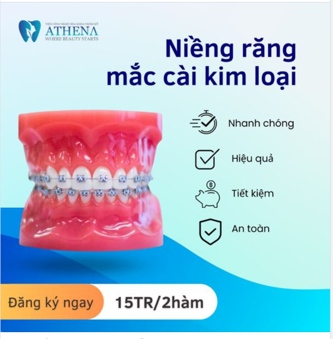 QUY TRÌNH NIỀNG RĂNG BẰNG MẮC CÀI ĐƯỢC THỰC HIỆN NHƯ THẾ NÀO