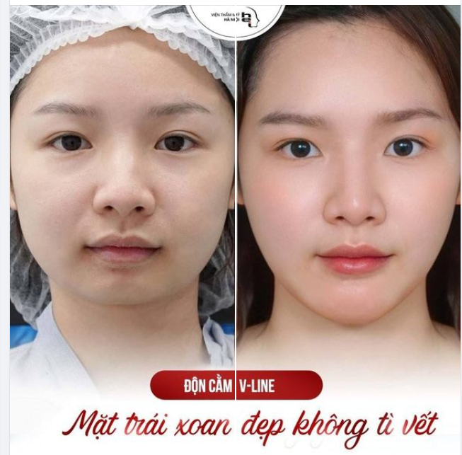 ĐỘN CẰM VLINE  KHUÔN MẶT TRÁI XOAN ĐẸP KHÔNG TÌ VẾT