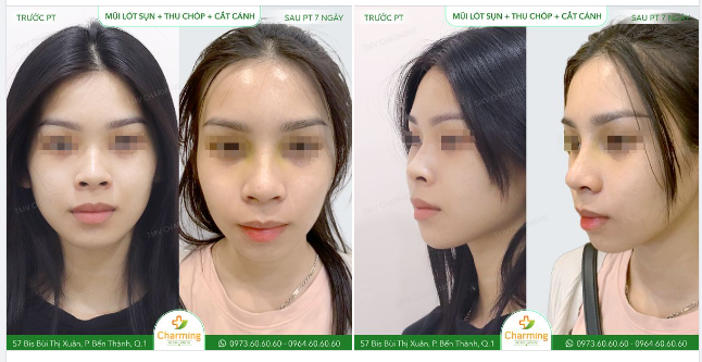 Chiếc mũi ban đầu của nàng khách không phải chiếc mũi quá xấu, nhưng để nó trở nên cân đối và hài hoà hơn với gương mặt, nàng khách đã thực hiện nâng mũi lót sụn, thu chóp và cắt cánh mũi tại Charming.