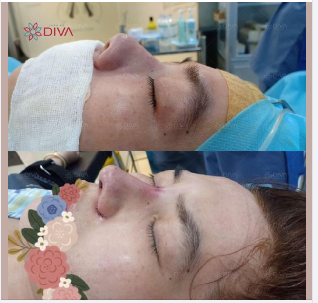KẾT QUẢ THẨM MỸ DÁNG MŨI THAY ĐỔI NHƯ THẾ NÀO?