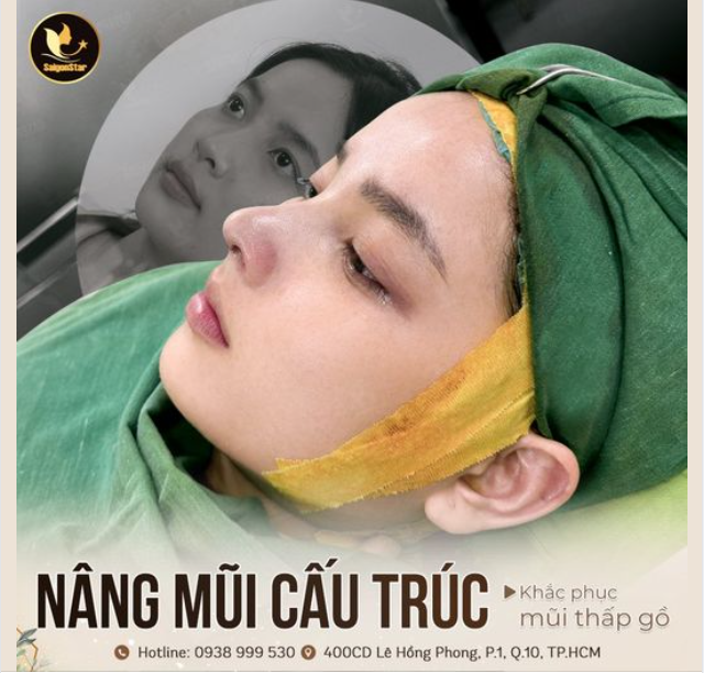 CÁI KẾT CÓ THỂ GỌI LÀ HOÀN MỸ SAU 60 PHÚT NÂNG MŨI CẤU TRÚC