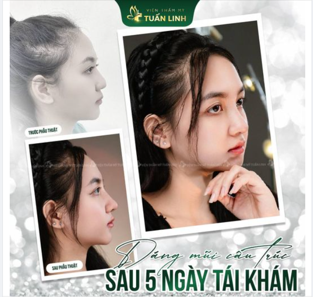 Mũi cấu trúc sửa lại sau 5 ngày thay nẹp, tái khám!!