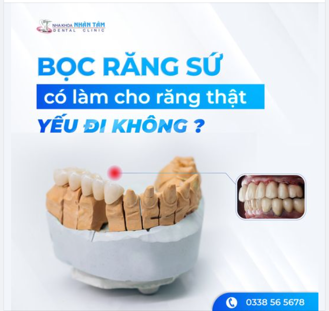 Bọc răng sứ có làm cho răng thật yếu đi hay không? 