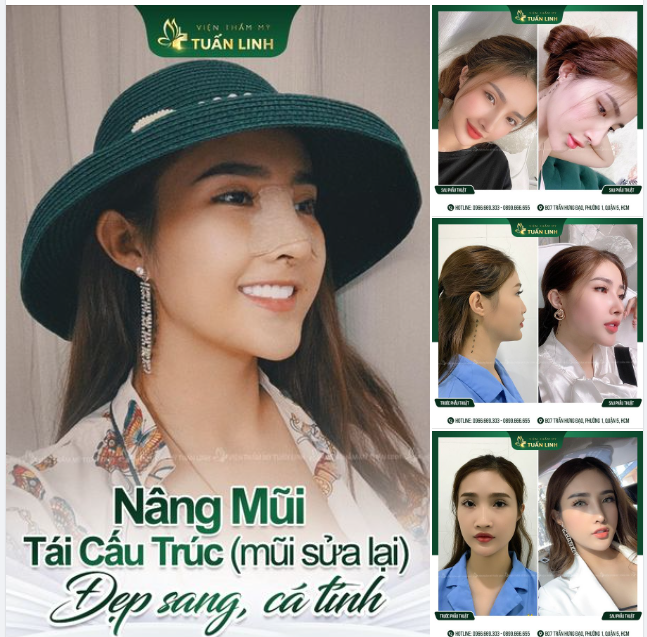 Nâng mũi - Đẹp từ khi nẹp mũi là có thật!