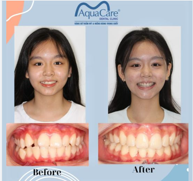 HÈ ĐẾN RỒI - NIỀNG RĂNG THÔI