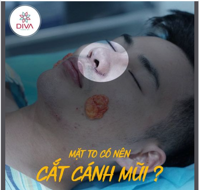 MẶT TO CÓ NÊN CẮT CÁNH MŨI ?