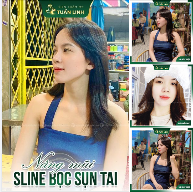 Mũi đẹp như ý với chi phí ""nhỏ xíu"!!