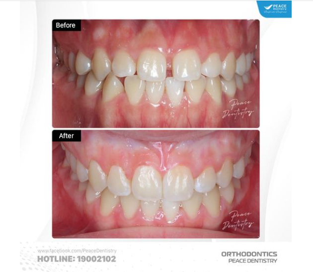 CA  NIỀNG RĂNG THƯA SAU 1.5 NĂM ĐIỀU TRỊ