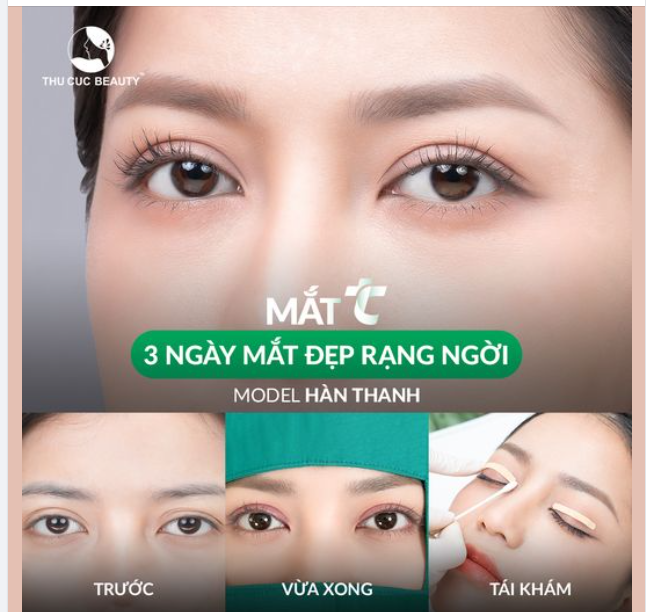 Tin vui cho các chị em mí lệch, đa nếp mí: Chỉ 5 suất Mắt TC -30% trong hôm nay