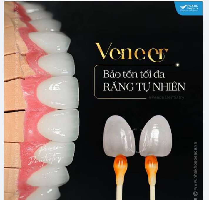 5 SỰ KHÁC BIỆT KHI LÀM VENEER TẠI PEACE DENTISTRY: